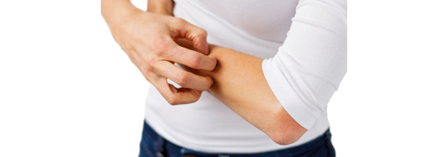 eczema