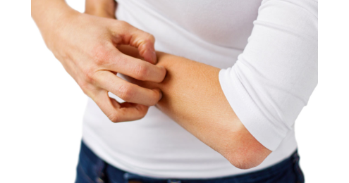 eczema eczema